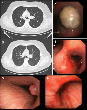 1)La TC tórax muestra una lesión que ocluye parcialmente la luz del bronquio principal derecho. 2)Visión endoscópica: lesión bronquial exofítica en el bronquio principal derecho que se extiende hasta el tercio distal de la tráquea. 3)TC de tórax de control sin alteraciones. 4)Visión endoscópica desde la tráquea distal tras realizar criorresección. 5)Visión endoscópica: lesión exofítica en bronquio principal derecho compatible con angiofibroma residual. 6)Visión endoscópica: tras realizar crioterapia en la pared del bronquio principal derecho.