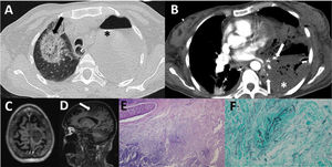 A) Corte axial de la TC torácica basal en ventana de pulmón, que muestra área en vidrio deslustrado con signo de halo invertido en pulmón derecho (flecha negra) e hidroneumotórax izquierdo (asterisco negro). B) Corte axial de la TC torácica con contraste intravenoso en ventana de partes blandas, que muestra áreas hipodensas sugestivas de infarto en segmentos basal anteromedial y lateral del lóbulo inferior izquierdo (asterisco blanco), con amputación proximal de las arterias segmentarias de las zonas afectas (flechas blancas). C y D) Corte axial de la RM T1 y sagital T1 que muestran lesión redondeada parasagital izquierda en forma de cuña (flechas blancas), sugestiva de corresponder a infarto venoso. E) Tinción de hematoxilina y eosina a 40 aumentos: parénquima pulmonar desestructurado, con extensas áreas de necrosis, debris celular e inflamación aguda. F) Tinción de plata metenamina a 200 aumentos: presencia de hifas en el interior de un vaso, con morfología compatible con mucor. Presencia en la periferia de levaduras compatibles con cándida.