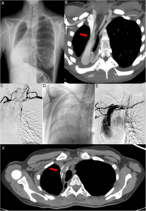 A) Radiografía de tórax PA. Neumonectomía derecha, herniación transmediastínica e hiperinsuflación pulmonar compensatoria contralateral. B) TC con CIV. Reconstrucción MIP. Estenosis a nivel proximal de la VCS. C) Flebografía. Estenosis objetivada mediante instilación de contraste intravenoso a nivel proximal de la VCS y circulación colateral. D) Imagen obtenida por radioscopia. Prótesis normoposicionada a nivel proximal de la VCS, inmediatamente posterior a la confluencia del tronco braquiocefálico derecho y la vena innominada. E) Flebografía. Reperfusión de la región estenótica de la VCS. F) TC con CIV. Reconstrucción MIP. Reperfusión de la VCS tras el implante de la prótesis vascular. CIV: contraste intravenoso; MIP: máxima proyección de intensidades; PA: posteroanterior; TC: tomografía computarizada; VCS: vena cava superior.