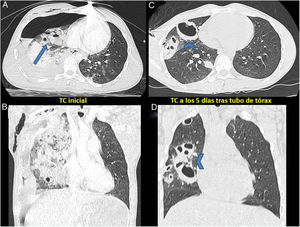 A y B) TCMD de tórax, corte axial y coronal: extensa hemorragia alveolar derecha en cuyo seno se identifican espacios quísticos con niveles hidroaéreos compatibles con laceraciones pulmonares (flecha). Hidroneumotórax y enfisema subcutáneo derechos. Pequeños focos contusivos pulmonares izquierdos. C y D) TCMD de tórax, corte axial y coronal: reexpansión pulmonar tras tubo de tórax, con práctica resolución de la hemorragia alveolar derecha. Los espacios quísticos hidroaéreos presentes en el estudio previo han perdido los niveles y presentan ahora un aspecto extraño en relación con neumatoceles postraumáticos (puntas de flecha).
