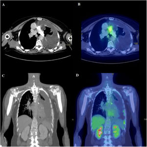 A: TC de tórax en ventana de partes blandas a la altura de las arterias pulmonares. Ocupación periférica e irregular de la luz de la arteria pulmonar principal izquierda, por material de densidad calcio. Corresponde al área de afectación endovascular por sarcoma intimal. Derrame pleural izquierdo de aspecto complicado, con atelectasia pasiva parcial del parénquima del lóbulo superior izquierdo (LSI). Engrosamiento irregular de la pleura parietal izquierda. B: PET-TAC. Corte axial (mismo nivel que en A). Se identifica aumento focal de metabolismo en la bifurcación de la arteria pulmonar (SUVmáx 5,54), que se corresponde con una zona de la lesión que presenta menor densidad de calcio. No se observa aumento de metabolismo en la imagen cálcica de arteria pulmonar izquierda. C: TC coronal de tórax y abdomen superior. Reconstrucción multiplanar con grosor de corte de 5 mm. Se observa derrame pleural izquierdo de aspecto complicado, con lesiones nodulares pleurales calcificadas tanto en pleura parietal como visceral, mediastínica y periférica. Corresponden a implantes pleurales. D: PET-TAC. Corte coronal (mismo nivel que en C). Se observa aumento de metabolismo en las imágenes nodulares calcificadas pleurales (SUVmáx 4,57), principalmente las de localización periférica inferior, en relación con implantes pleurales.