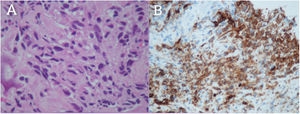 Anatomía patológica de biopsia con aguja gruesa guiada por ecografía (BAG) de la lesión calcificada pleural izquierda. A: Descripción microscópica: Proliferación estromal sarcomatosa, formada por una proliferación moderadamente densa de células de núcleos alargados u ovoides, agrandados e hipercromáticos, marcadamente atípicos y con frecuentes figuras de mitosis. Se entremezclan con tejido colágeno hialino y hueso neoformado de tipo trabecular. B: Estudio inmunohistoquímico: Positividad de células tumorales con marcadores vasculares (WT1 tinción nuclear en células estromales y citoplasmática en relación con elementos vasculares; y con CD31).