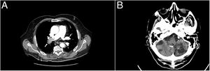 A: Filling defect in right main artery revealed in CTA chest. B: Brain computed tomography scan without signs of rebleeding three weeks after the haemorrhagic transformation.