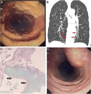 (A) Endoscopic view of the trachea. Coarse, yellowish plaques and friable mucosa interspersed with areas of normal mucosa. (B) CT scan, coronal view: Discrete varicose bronchiectasis are visible in the lower lobes (arrows). Signs of diffuse cellular bronchiolitis are evident, and no lung infiltrates were noted. (C) Histologic examination of a pseudomembrane. Submucosal inflammation with a dense eosinophilic infiltrate due to the presence of fungi is appreciated (the arrows point to the bronchial lumen). (D) Repeat bronchoscopy after three weeks of treatment showed marked improvement of the lesions.