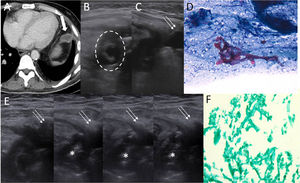 A) TC torácica axial en ventana de partes blandas que muestra una colección líquida con realce de sus paredes en mediastino, a nivel supradiafragmático (flecha gruesa), donde se había interpuesto la grasa proveniente del epiplón (epiploplastia) a raíz de la pericardiectomía previa. B) Ecografía torácica que muestra colección anecoica en grasa mediastínica con imagen circunferencial ecogénica en su interior (círculo discontinuo). C) Punción percutánea de la colección mediante aguja 20G (flechas finas). D) Muestra citológica que evidencia fondo necrótico con celularidad inflamatoria constituida por leucocitos polimorfonucleares, así como estructuras micóticas irregulares compatibles con mucormicosis. E) Ecografía torácica que muestra punción torácica (flechas finas), con instilación progresiva de anfotericina B intracavitaria (asterisco). F) Pieza quirúrgica que evidencia nódulo pleural necrótico con infección micótica morfológicamente compatible con mucormicosis.