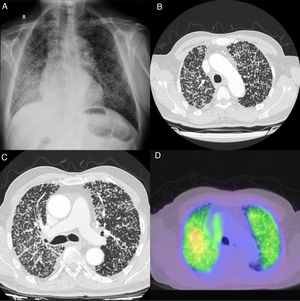 A. Patrón micronodular (miliar) en radiografía de tórax PA, de distribución difusa en ambos hemitórax y de localización tanto perilinfática como centrolobular, que resultó inespecífico. Estos hallazgos pueden corresponder a enfermedad infecciosa (TBC, fúngica), inflamatoria (sarcoidosis, neumoconiosis, etc.) o proceso maligno. B y C. Distintos cortes de TC de tórax: patrón micronodular pulmonar difuso bilateral con distribución aleatoria. D. PET-TAC de tórax: incremento difuso del metabolismo, indicativo de metástasis.
