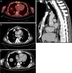 (A) Axial fused PET/CT image prior to surgery. White arrow showing an abscess. (B) Chest CT (axial image, mediastinal window) prior to surgery showing an abscess (white arrow) surrounding the sternum. (C, D) Chest CT (axial [C] and sagittal [D] images, mediastinal window) after surgical debridement.