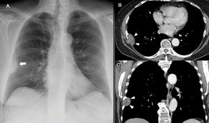 Radiografía simple (A), lesión de características extrapulmonares en la base del hemitórax derecho (flecha). Cortes axial (B) y coronal (C) de TC de tórax, lesión sólida (cabezas de flechas) heterogénea de 45 x 30 extraparenquimatosa, afectando al espacio intercostal entre el 7° y 8° arcos costales derechos. Asocia destrucción ósea parcial con reacción esclerótica y expansiva del séptimo arco costal.