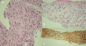 Anatomía patológica de biopsia con aguja gruesa guiada por ecografía (BAG) de la lesión de partes blandas localizada en la región intercostal lateral del hemitórax derecho. A: Descripción microscópica: Proliferación estromal fusocelular, moderadamente celular, no atípica (zona Antoni A). HE x 100. B: Descripción microscópica: Proliferación estromal fusocelular, hipocelular, no atípica con datos de sangrado (zona Antoni B). HE x 100. C: Estudio inmunohistoquímico: Positividad intensa y difusa para S100. IHQ x 100.