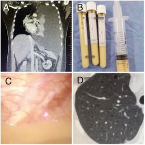 A: TC de tórax al ingreso donde se aprecia derrame pleural masivo izquierdo. B: Líquido pleural compatible con quilotórax. C: Toracoscopia médica donde se observa el líquido pleural macroscópicamente. D: TACAR de tórax donde se visualizan lesiones quísticas pulmonares.