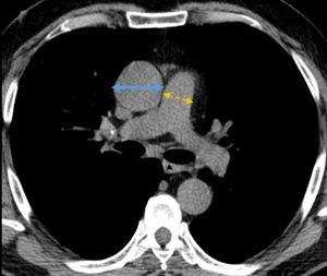 PA:A ratio measured at pulmonary artery bifurcation. PA:A≤1 (normal) PA:A>1 (enlarged). PA: pulmonary artery diameter (blue continue line), A: ascending aorta diameter (yellow discontinuous line).