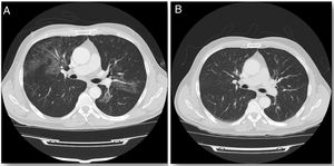 A) Tomografía computarizada (TC) de tórax con contraste en el momento del diagnóstico. B) TC de tórax con contraste a los dos meses de finalizar el tratamiento.