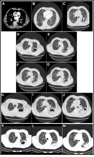 (A) Thoracic computed tomography (CT) angiography image (mediastinal window) on day 7 of admission in which central filling defects were observed in lobar, segmental and subsegmental pulmonary arterial branches of the left lower lobe (LLL), compatible with a diagnosis of acute pulmonary embolism (PE) (white arrows). (B) Thoracic CT angiography image (pulmonary parenchyma window) on day 7 of admission in which a severe extensive diffuse bilateral multilobar pulmonary parenchymal involvement of the reticular interstitial type was observed, characterized by increased attenuation in ground glass and thickening of interlobular and intralobular septa, compatible with a diagnosis of SARS-CoV-2 pneumonia, associated with extensive generalized vacuolization of the lung parenchyma compatible with marked centrilobular and paraseptal pulmonary emphysema. (C) Thoracic CT image (lung parenchyma window) on day 32 of admission in which it was observed that, on the previous reticular interstitial lung pattern, a consolidative area appeared with incipient cavitations with a tendency to coalescence in the upper segment (S6) of the LLL (surrounded by a discontinuous blue circumference), related to acute pulmonary infarction (secondary to acute PE) and incipient signs of subacute invasive pulmonary aspergillosis (SAIPA). (D–G) Thoracic CT images (lung parenchyma window) on day 47 of admission in which it was observed that a true large cavitated infiltrate had been established in the LLL (12.5cm in maximum diameter approximately) with thick walls and with reticular content inside compatible with an aspergillary fungal lung abscess (SAIPA) (surrounded by a broken blue ellipse) with possible super-added bacterial superinfection (possible bacterial lung abscess) on a bed of acute pulmonary infarction due to acute PE, of bilateral pneumonic affectation by SARS-CoV-2 and of emphysematous lung parenchyma. Adjacent, a predominantly left basal bilateral pleural thickening reaction was observed in the context of SAIPA. (H–J) Thoracic CT images (lung parenchyma window) on day 74 of admission in which it was observed that the cavitated infiltrate located in the S6 of LLL, of similar size (surrounded by a dashed blue ellipse), had been partially filled with liquid content forming an air-fluid level. (K–M) Thoracic CT images (lung parenchyma window) on day 104 from the date of hospital admission and on day 26 from the date of discharge from the hospital, after two months with antifungal therapy with posaconazole, in which it was observed that the cavitated infiltrate located in the S6 of the LLL (surrounded by a dashed blue ellipse) had decreased considerably in size (from 12.5 to 6.1cm in larger diameter) and whose content had been more structured adopting a spherical morphology constituting a “fungal ball” and thus resembling more of a chronic cavitary pulmonary aspergillosis (CCPA), to which SAIPA had evolved in this patient.12,13