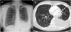 (A) Posteroanterior chest X-ray: Mild left pleural effusion. (B) AngioCT Chest: Countless pulmonary cysts distributed throughout the lung parenchyma with associated left pleural effusion.