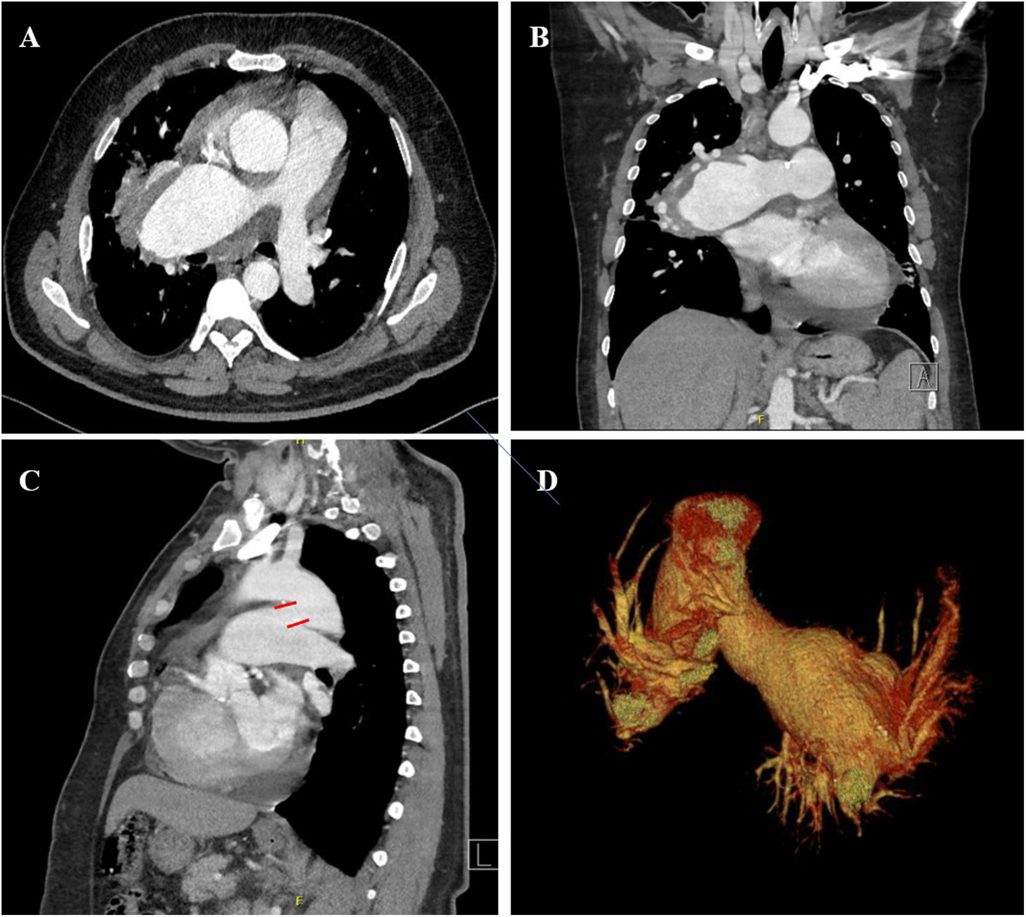 Giant Right Pulmonary Artery Aneurysm and Patent Ductus Arteriosus in ...