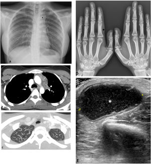 A) Radiografía de tórax demuestra un moderado ensanchamiento mediastínico superior izquierdo (*), así como un hilio izquierdo prominente de morfología nodular (flecha). B) La TC torácica en la ventana de mediastino muestra adenopatías mediastínicas izquierdas, con centro hipodenso. C) En la TC torácica en la ventana de pulmón se observa algún nódulo subcentimétrico en el ápex derecho (flechas). D) En la radiografía de las manos se aprecia mínima tumefacción de partes blandas a nivel de la falange proximal del segundo dedo de la mano izquierda (*). E) La ecografía del codo derecho muestra la presencia de una colección (*), hipoecogénica y con ecos puntiformes en su interior, de 35mm de diámetro máximo, ubicada en la partes blandas del codo derecho y compatible con absceso de partes blandas.