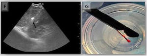 F)Ecobroncoscopia lineal que muestra la criosonda dentro del ganglio mediastínico. G)Ecobroncoscopio con criosonda 1,1mm dentro del canal de trabajo. La punta de la criosonda tiene la muestra ganglionar obtenida por criobiopsia. Adaptado de Ariza-Prota et al.48.