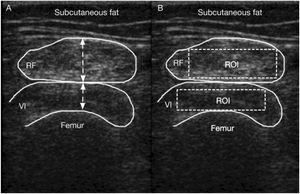 A)Grosor muscular del recto femoral (RF) y del vasto intermedio (VI). B)Región de interés (ROI) seleccionada en el recto femoral y el vasto intermedio54.