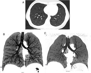(a) Shows the centrals bronchiectasis and how they change during the inspiration (b) and expiration (c) chest CT.