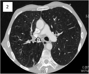 Metallic foreign body with turbin inside the right main bronchus on chest computerized tomography.