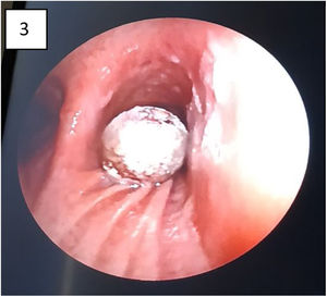 Endobronchial view with its rounded edge of crak pipe in the right main bronchus.