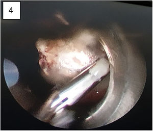 Grip with rigid forceps through the rigid bronchoscope.