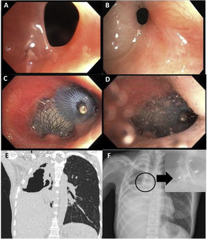 (A and B) Endoscopic view of BPF with 6mm in the right lower bronchial stump (A) and BPF with 2mm in the right upper bronchial stump (B). (C and D) Endoscopic view of PFO Occluder and Duct Occluder with complete occlusion of the BPF of the right lower and right upper bronchial stump, respectively. (E) Chest computed tomography demonstrates the BPF of the right bronchial stump. (F) Chest radiograph shows both devices in place.