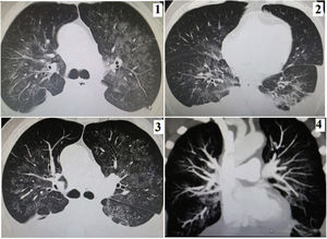 (1) August: mild pleural effusion and ground glass: 35–40%. (2) Early September: increase in pleural effusion and decrease in ground glass. (3) End of September: similar characteristics. (4) Reconstruction of coronal section of angio tomography without evidence of vascular thrombotic lesions.