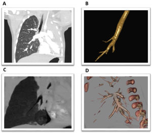 (A) Coronal section of CT chest showing the tracheal bronchus. (B) 3D reconstruction of the patient