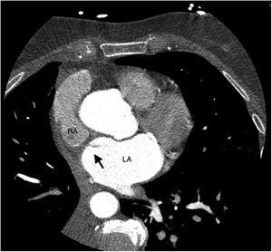 Cardiac CT scan. Black arrow shows the blood flow from the right atrium (RA) to the left atrium (LA), noting the interauricular communication.