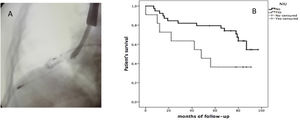 (A) Fluoroscopy with rigid bronchoscopy, inserted cryoprobe through videobronchoscopy and less than 1cm from the pleural surface. (B) Kaplan–Meier survival curve in diagnosis of UIP after TBCx.