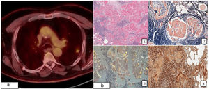 (a) Left upper lobe nodule (SUVmax 2.98) in 18F-fluorodeoxyglucose positron emission tomography (FDG-PET). (b) 1, Deposits of acellular eosinophilic amorphous material associated with an extensive inflammatory infiltrate (hematoxylin–eosin) 2, Congo red stain 3, green birefringence of Congo restained tissue under cross-polarization 4, immunohistochemistry, Kappa light chains.