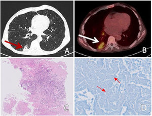 (A) Chest CT: consolidation at the level of the right lower lobe with pleural contact (red arrow). (B) PET-CT: bilobed consolidation in the periphery of the right lower lobe (white arrow) and right hilar lymph nodes with pathologic FDG uptake. (C) Pathology: giant cells and necrosis (10×). (D) Microbiology: presence of acid fast bacilli by Ziehl Neelsen stain (little red arrows).