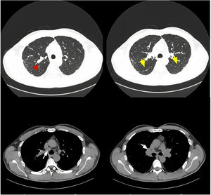 Mediastinal adenopathies (white arrows) and pleuroparenchymal involvement in the form of perilymphatic nodules (red asterisk) and pleural nodular thickenings and fissures (yellow arrowheads).