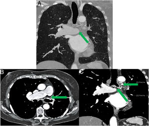 (A) The absence of the left pulmonary artery and ipsilateral pulmonary hypoplasia in a coronal section of the pulmonary window. (B) Axial view of the mediastinal window showing contrast uptake only in the right pulmonary artery. (C) Coronal section in mediastinal window, showing hypertrophy of bronchial arteries with compensation for the agenesis of the left pulmonary artery.