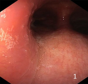 Lado izquierdo de la tráquea distal, con aspecto de infiltración.