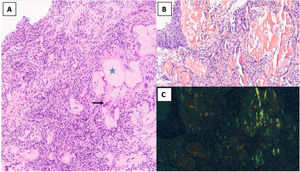 A) Mucosa bronquial con depósito de material eosinófilo, amorfo y acelular (estrella), separados por tejido conectivo con inflamación crónica y reacción gigantocelular de tipo cuerpo extraño (flecha). Tinción de hematoxilina eosina a 80x. B) Estudio inmunohistoquímico con rojo Congo positivo. Tinción de rojo Congo a 100x. C) Estudio de birrefringencia verde manzana. Tinción rojo Congo pero que evidencia la birrefringencia verde manzana bajo luz polarizada, igualmente a 100x.