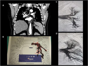 A) Imágenes obtenidas mediante angiotomografía de tórax con inyección de contraste por vía intravenosa, corte coronal a nivel de vasos pulmonares principales donde se observa trombo central y obstrucción casi total de arteria pulmonar izquierda. B) Mapa vascular INARI FlowTriever®, con material trombótico extraído. C) Angiografía pulmonar de a. pulmonar izquierda previa a la trombectomía mecánica. D) Angiografía pulmonar de a. pulmonar izquierda posterior a trombectomía mecánica.
