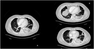 Imágenes obtenidas mediante angiotomografía de tórax con inyección de contraste por vía intravenosa, corte transversal a nivel cardiaco, donde se observa, en el lóbulo inferior izquierdo, un área consolidada sugerente de infarto pulmonar.