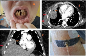 (A) Severe gingival retraction with pyorrhea and missing teeth. (B, C) Chest CT, axial and coronal images. Necrotic atelectasis of the middle and lower lobe (orange arrows), contiguous to a heterogeneous hyperdensity with mass effect in the chest wall (red arrows). Gas is seen within both lesions. (D) On day 3 after surgery, negative pressure wound therapy was applied with the use of 3M™ ActiV.A.C.™ device to accelerate the scarring process.