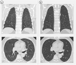 Thorax CT (coronal and axial images). (a) Centrilobular nodules and air-trapping, suggesting non-fibrotic HP. (b) Disappearance of the radiological pattern of HP, after using FFP2 mask.