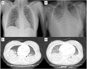 Imaging tests. (A) Chest radiograph with no pleuroparenchymal alterations at admission. (B) Extensive bilateral pulmonary condensations on chest radiograph 48h after admission. (C and D) Extensive consolidative foci affecting the lower, middle and lingula lobes with air bronchogram and associated pleural effusion on computed tomography scan 48h after admission.