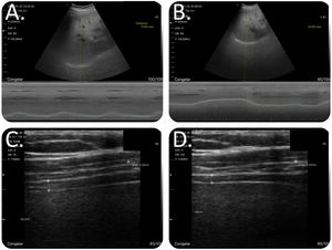 Methodology for examining the diaphragm. To measure diaphragmatic mobility, the patients were placed in supine decubitus, with the bed angled at 30–45°, with the ultrasound probe below the costal arch in the midclavicular line and with the ultrasonic beam in the cephalic-dorsal direction, pointing toward the right shoulder. The diaphragm thickness was measured with the patient seated and the shoulder at 90°. The ultrasonic beam was aimed in the craniocaudal direction, perpendicular to the direction of the muscle fibers, including the pleural and peritoneal membrane. (A) Combined B/M-mode study with convex probe during a maneuver at tidal volume. In M-mode, we observed the sinusoidal image that represented the diaphragm