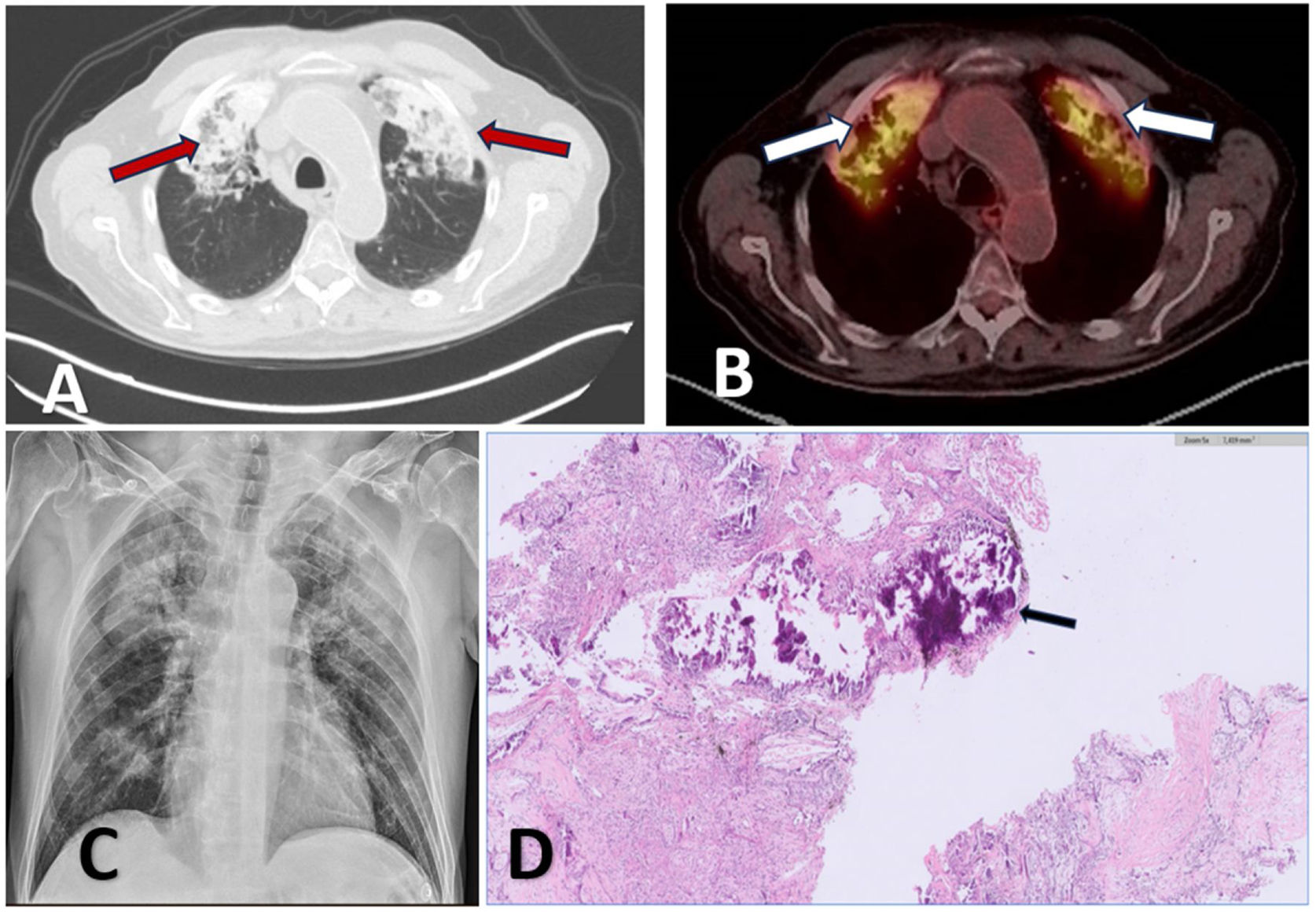 Differential Diagnosis of Pulmonary Calcifications: A Complex Mosaic ...