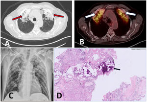 (A) CT: high attenuation consolidations with foci of calcification in the apical and anterior segments of both upper lobes (red arrows). (B) PET-CT: fibro-interstitial changes in both anterior segments of the upper lobes with intense fluorodeoxyglucose uptake (right SUVmax 7.0 and left SUVmax 6.8) (white arrows). (C) Chest radiography: extensive consolidations in apical segments of both upper lobes. (D) Pathology: extensive tissue calcification, associated with fibrosis and accompanied by chronic inflammatory infiltrate with foreign body-type gigantocellular reaction (black arrow).