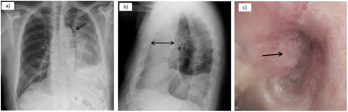 Luftcycle Sign The Luftsichel Sign is Still in Effect | Open Respiratory Archives