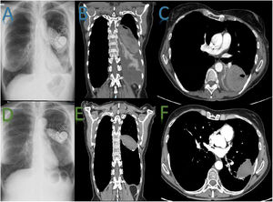 (A) Chest X-ray: mild impingement of the right costophrenic sinus, suggestive of left pleural effusion, along with homogeneous opacity in the left mid-lung field. (B) Thorax computer tomography (CT): intracisural image suggestive of hematoma due to its homogeneity and attenuation, confirming the presence of left pleural effusion and atelectasis of the left lower lobe. (C) Axial image, thorax CT: intracisural image suggestive of hematoma due to its homogeneity and attenuation, confirming the presence of left pleural effusion and atelectasis of the left lower lobe. (D) Chest X-ray: reduction of hematoma size and resolution of the previously observed pleural effusion in the left area, with normalization of the corresponding costophrenic space. (E) Thorax CT: notable reduction in the size and extent of the previously identified intracisural hematoma. The attenuation of the hematoma has significantly improved, indicating partial resolution. The disappearance of atelectasis in the left lower lobe is confirmed, with complete expansion of pulmonary structures in that region. There is no evidence of pleural effusion on the CT scan, suggesting complete resolution of this finding. (F) Axial image, thorax CT: reduction of hematoma size, disappearance of effusion and absence of atelectasis. Notable improvement compared to previous studies.