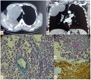 (A and B) Computed tomography chest images showing a large, relatively well-defined, heterogenous pulmonary mass in the right upper lobe, measuring 24cm×13cm. (C) Histopathology shows large sheets of small round cells with perivascular arrangement (HEA50 ×4). (D) Scattered pyknotic cells corresponding to apoptotic cells (HEA50 ×25). (E) Immunohistochemistry photomicrograph showing tumor cells positive for CD99.