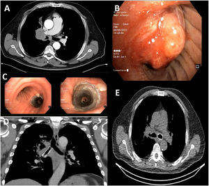 (A) CT with a right hilar mass with wide mediastinal contact and invasion and stenosis of the right main bronchus, right superior lobar bronchus, and intermediate bronchus. (B) Flexible bronchoscopy with a neoproliferative lung cancer. (C) STENT SEMS LEUFEN 14*40 in the right main bronchus. (D) CT chest coronal section, prosthesis in RMB. (E) Pulmonary ventilation SPECT with axial tomography, migration of stent to LMB.