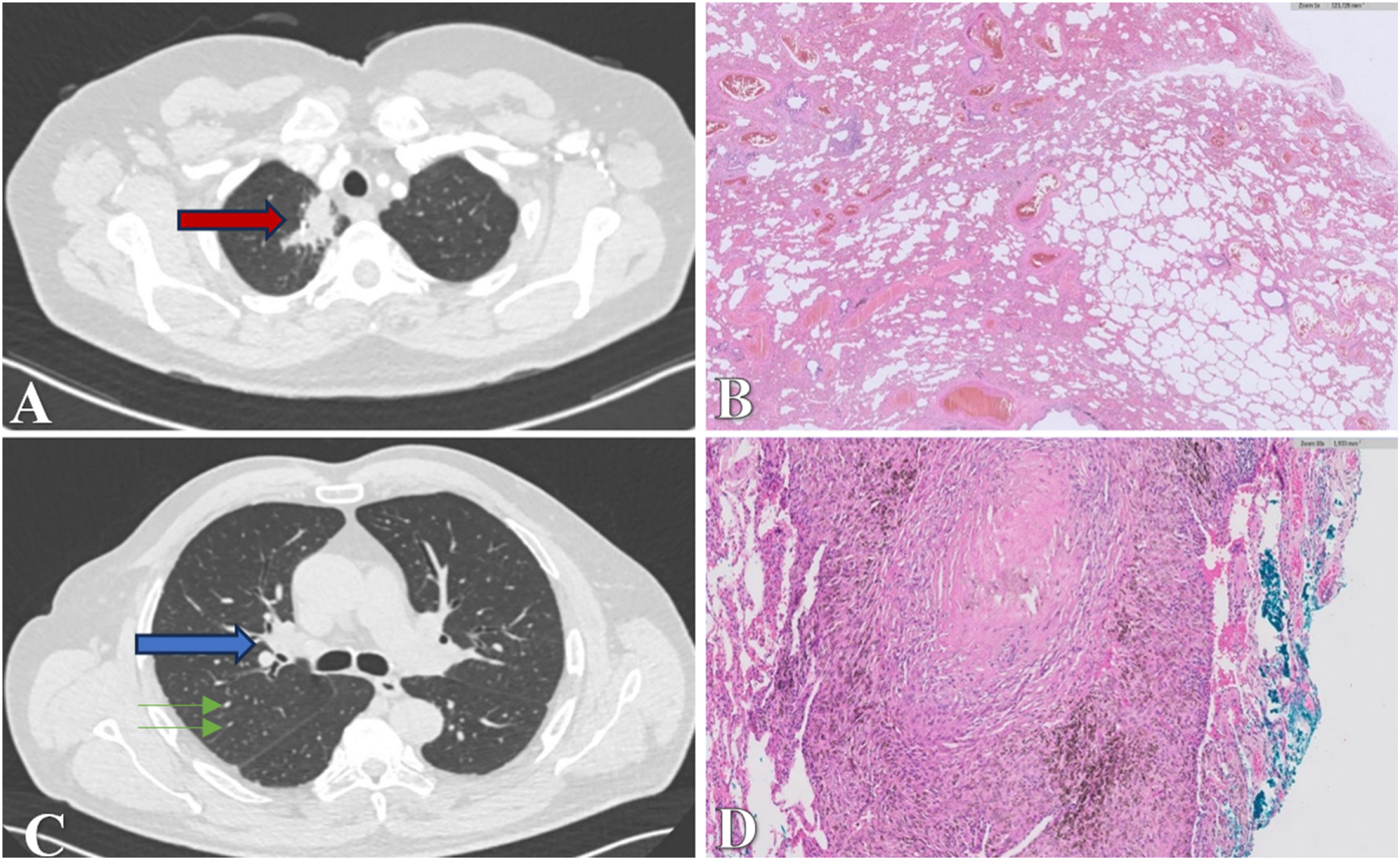 In the Intriguing Shadow of Malignancy: Pulmonary Hyalinizing Granuloma ...